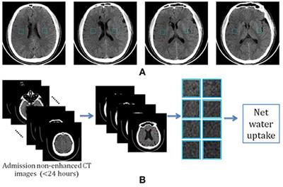 Image Patch-Based Net Water Uptake and Radiomics Models Predict Malignant Cerebral Edema After Ischemic Stroke